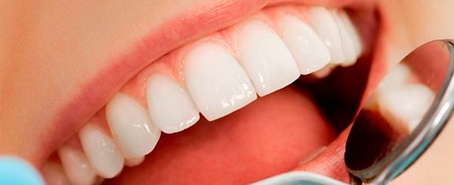 limpieza implantes dentales