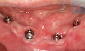 paciente despues implantes subperiosticos IDIM clinica de implantes dentales en valencia