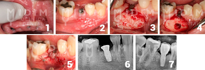 caso clinico patologia periapical al implante