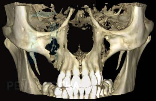 plan de tratamiento implantes subperiosticos idim clinica de implantes dentales en valencia