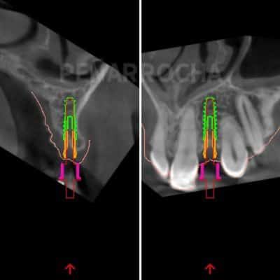 planificacion cirugia guiada implantes en un dia IDIM clinica de implantes dentales en valencia