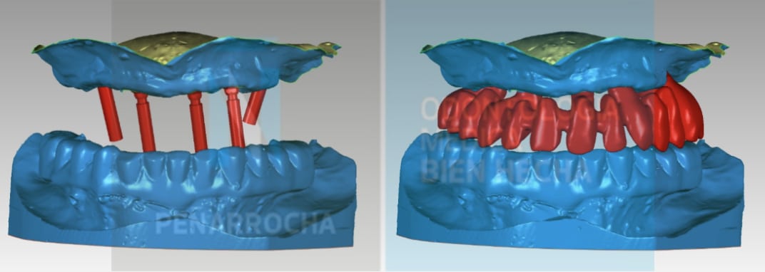 planificacion y diseno digital implantes dentales sin tornillos idim clinica de implantes dentales en valencia