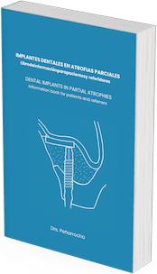portada implantes dentales atrofias parciales
