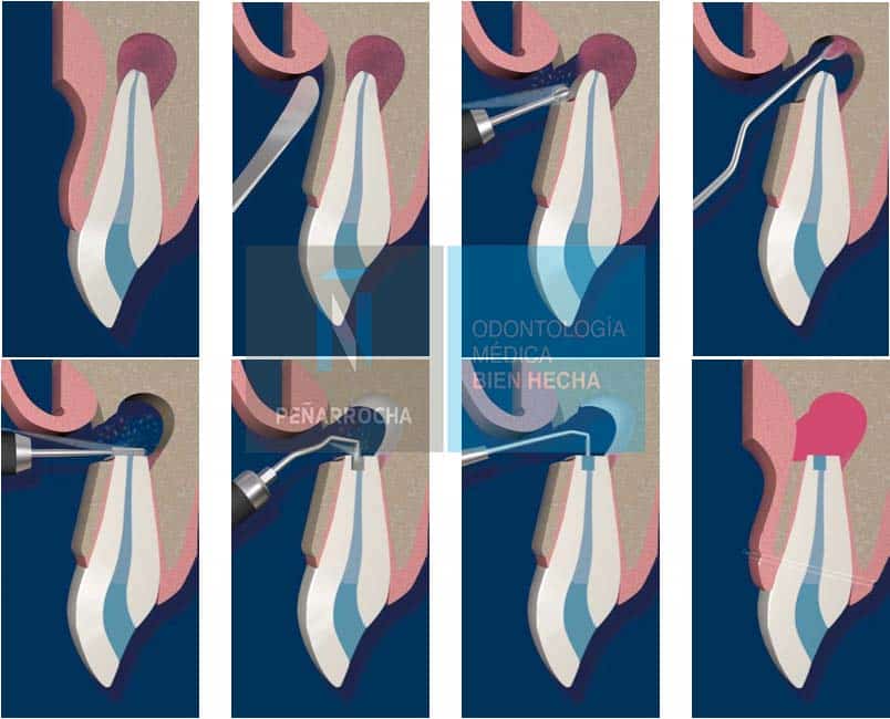 proceso cirugia periapical tratamiento endodoncia mal hecha idim clinica de implantes dentales en valencia 