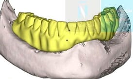 durante implantes subperiosticos IDIM clinica de implantes dentales en valencia