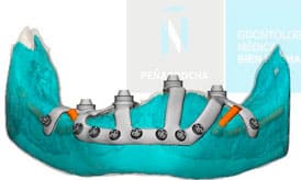 proceso de trabajo de los implantes subperiosticos IDIM clinica de implantes dentales en valencia