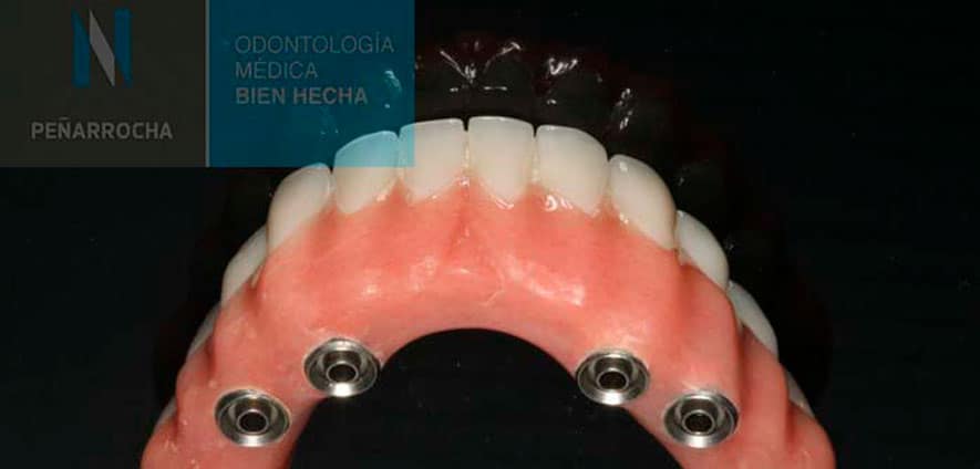 protesis fija implantes all on four en valencia idim clinica de implantes dentales en valencia