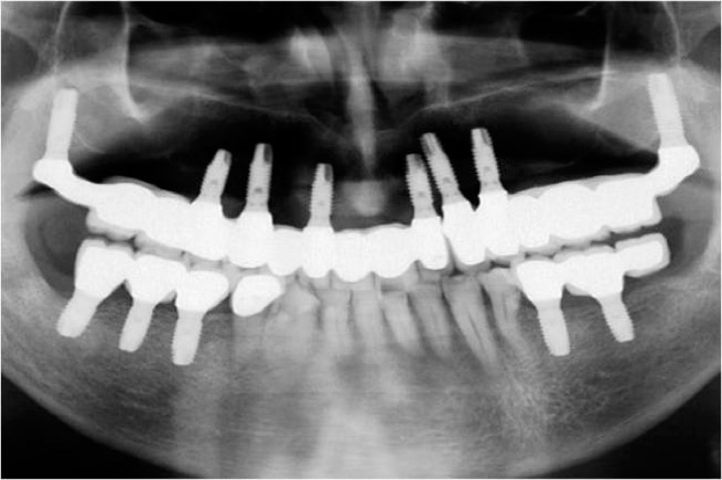 Pterygoid implant x-ray 