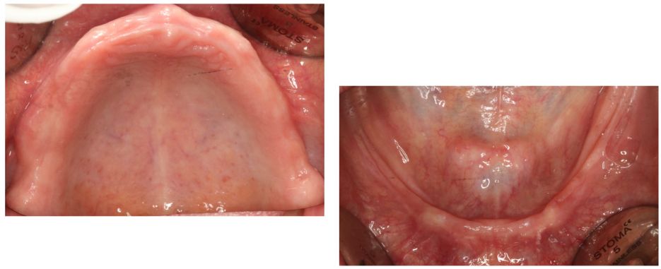 poco hueso maxilar por que se produce la atrofia maxilar IDIM clinica implantes dentales valencia