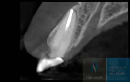 radiografia antes paciente caso implantes inmediatos idim clinica de implantes dentales en valencia