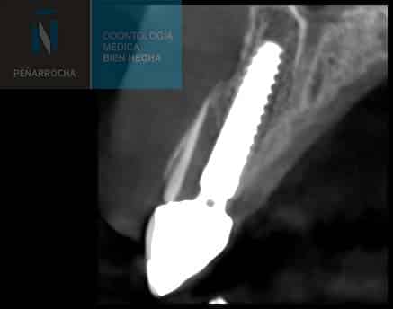radiografia despues paciente implantes inmediatos idim clinica de implantes dentales en valencia
