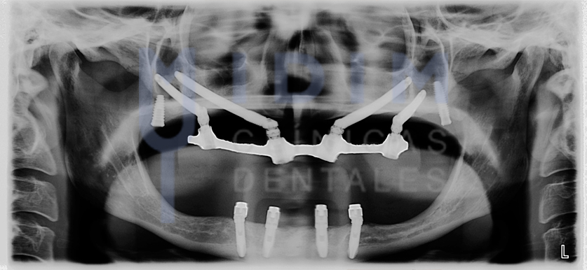 radiografia de paciente con implantes cigomaticos IDIM instituto de implantologia dental clinica de implantes dentales en valencia