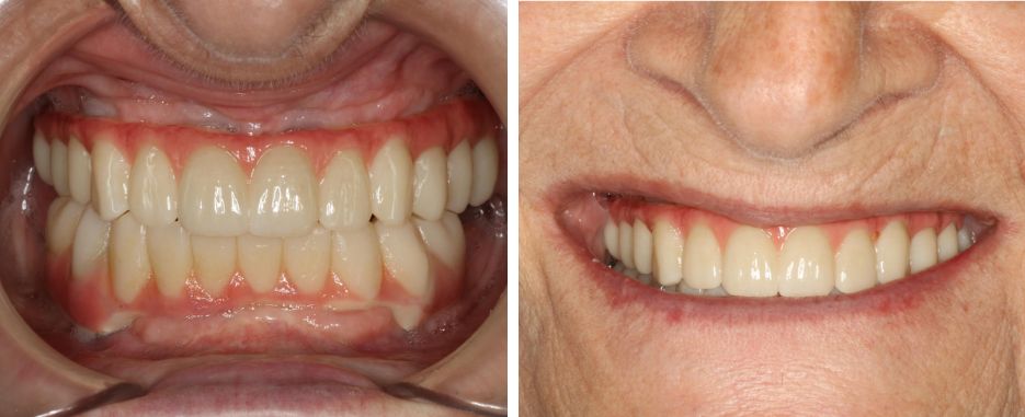 soluciones atrofia maxilar por que se atrofia el hueso de la mandibula IDIM clinica implantes dentales valencia 