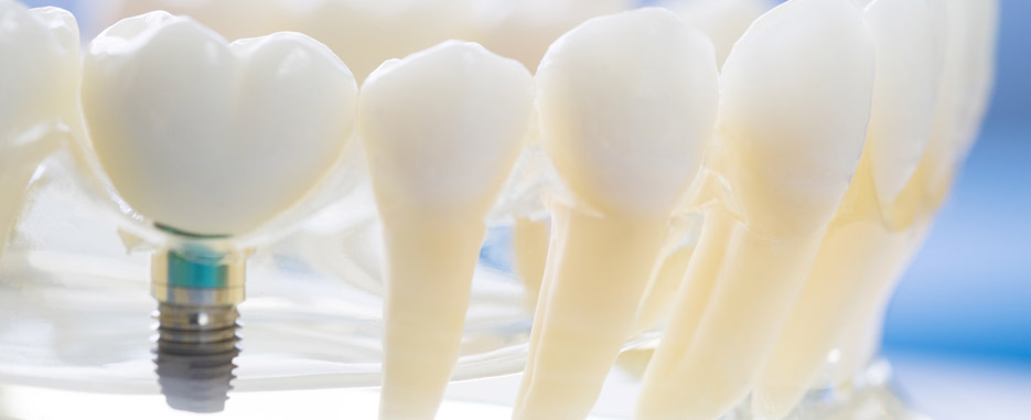 tipos de implantes y pilares implantologicos tipos implantes