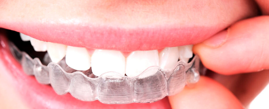 ventajas del tratamiento de invisalign