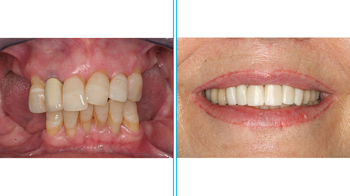antes-despues-implantes-dentales-puente-anterior
