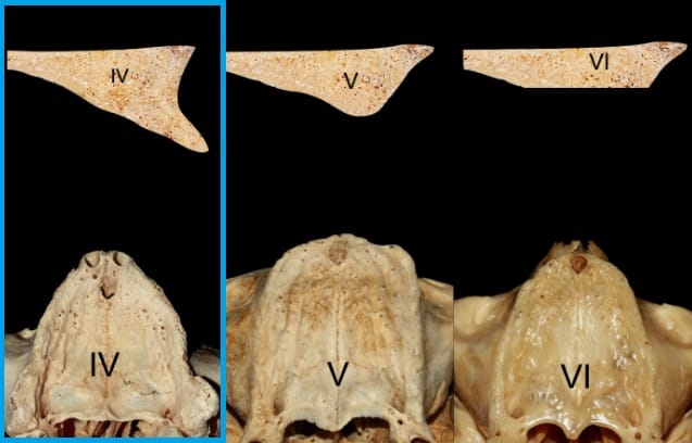 atrofia osea moderada grado iv implantes palatinizados idim clinica de implantes dentales en valencia