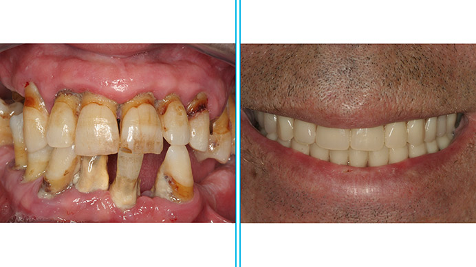 carga-inmediata-implantes-dentales-antes-despues-juan-antonio