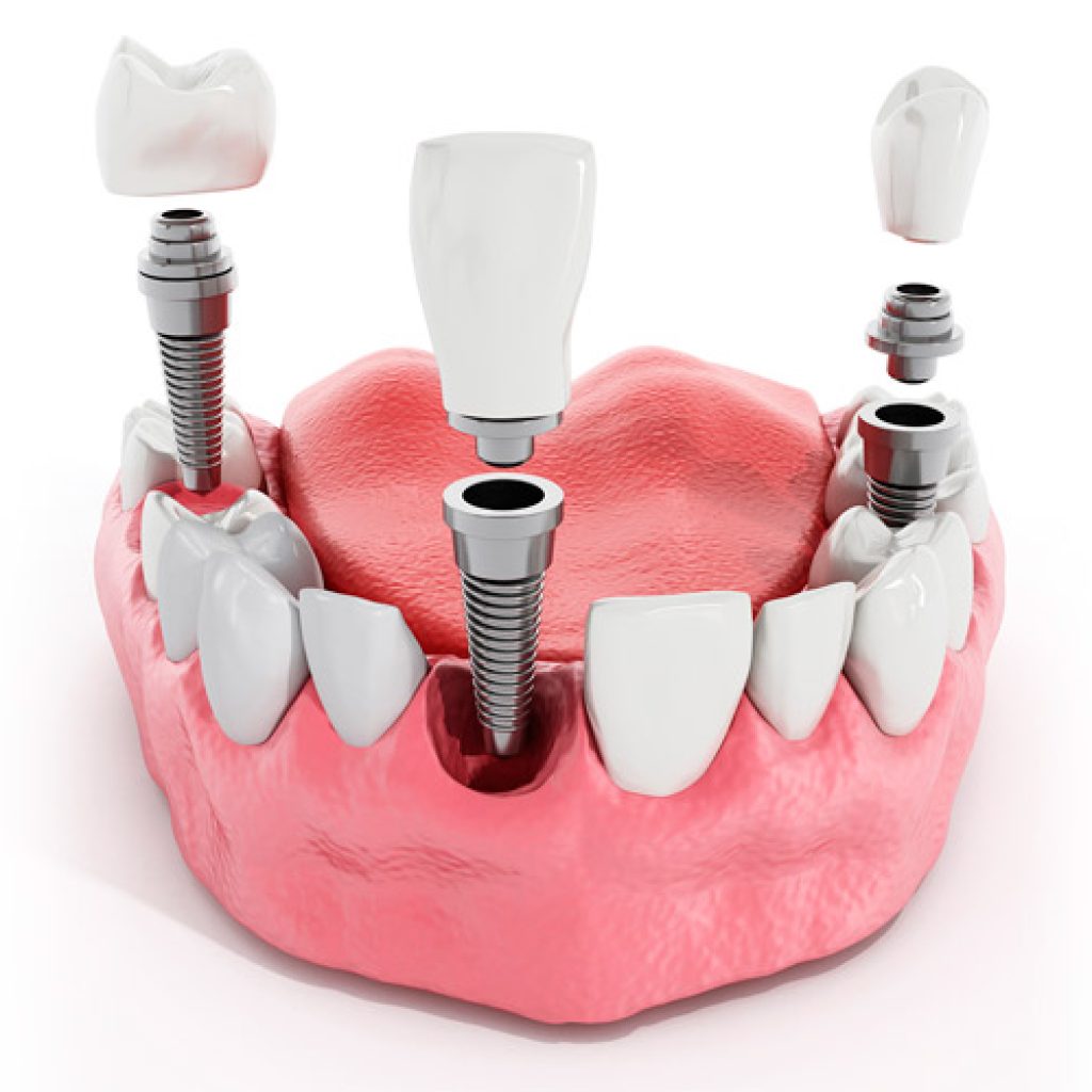 Clínica especialista en implantes dentales