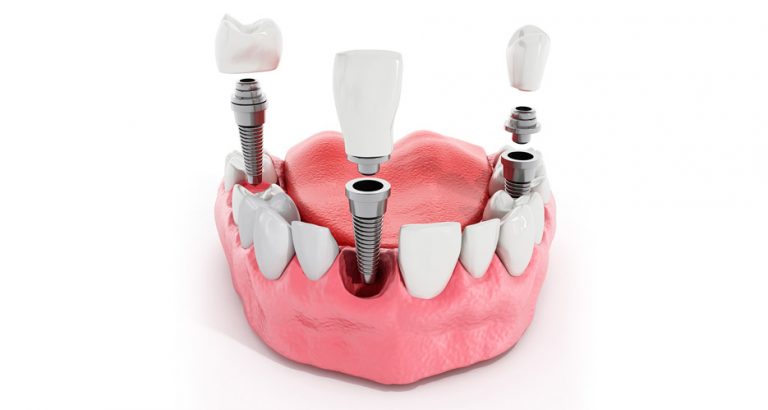 Clínica especialista en implantes dentales