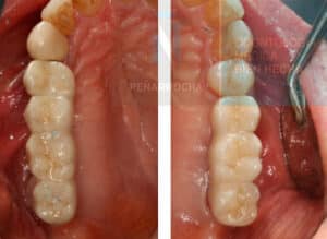 Placement of the final prosthesis for subperiosteal implants at IDIM, dental implant clinic in Valencia