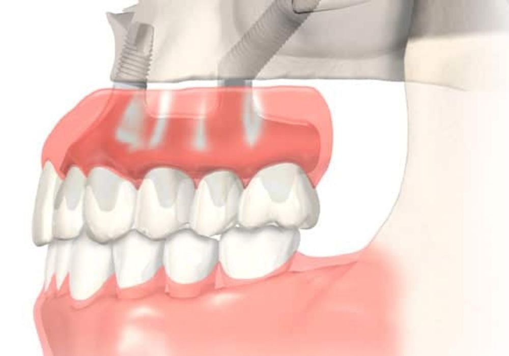 como es el tratamiento implantes cigomaticos