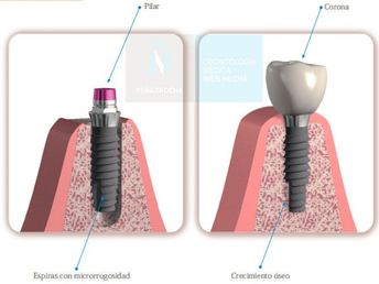 como es un tratamiento de implantes dentales en valencia idim clinica de implantes dentales en valencia
