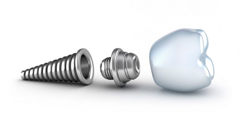 complicaciones mas frecuentes con implantes dentales