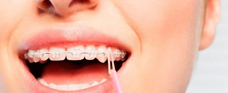 consejos para el dolor por brackets recien puestos