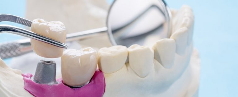 cuando acudir al implantologo dental