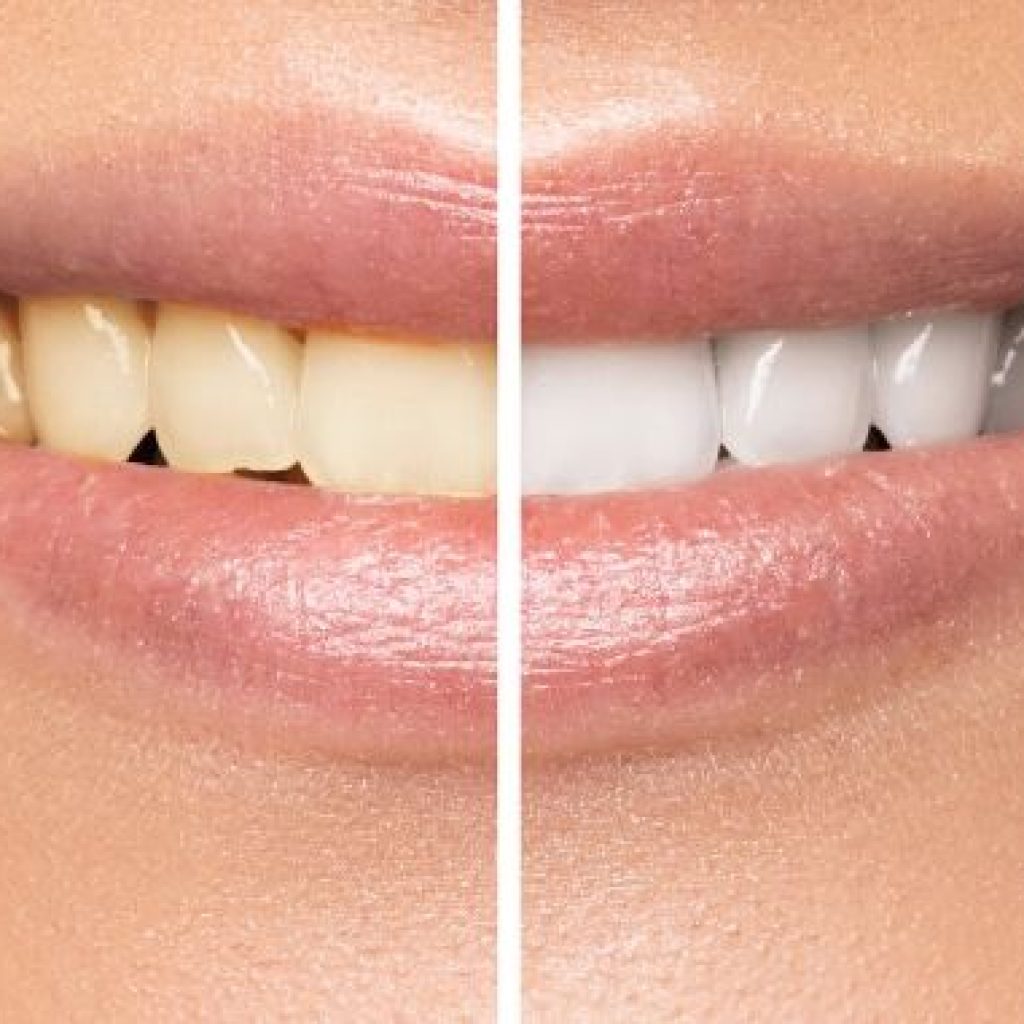 dientes afectados por tetraciclina