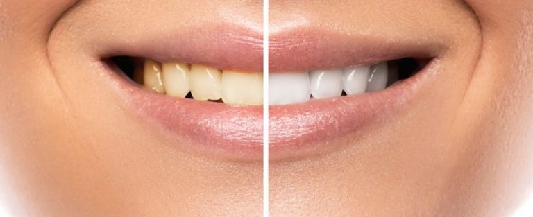 dientes afectados por tetraciclina