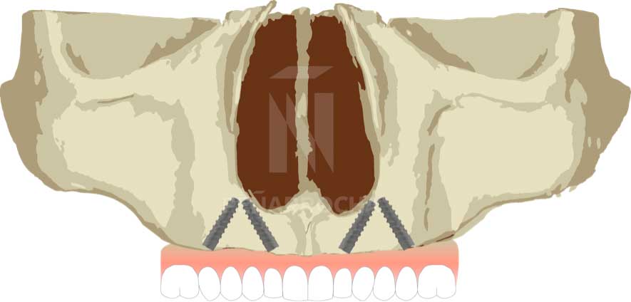 diseno implantes angulados idim clinica de implantes dentales en valencia