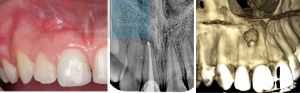 ejemplo endodoncia mal hecha portada idim clinica de implantes dentales en valencia