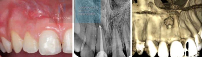 example failed root canal treatment idim dental implant clinic in Valencia