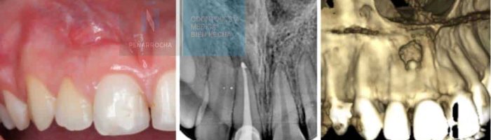 example failed root canal treatment idim dental implant clinic in Valencia