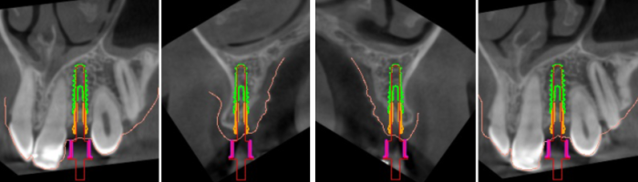implantes dentales sin cirugia en valencia IDIM clinica de implantes dentales en valencia