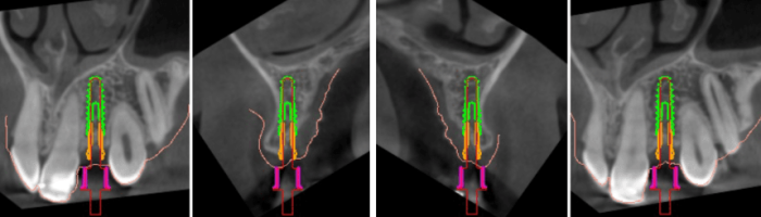 implantes dentales sin cirugia en valencia clinica de implantes dentales en valencia
