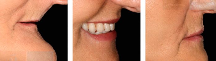 maxilar atrofico soluciones con implantes dentales sin hueso idim clinica de implantes dentales en valencia