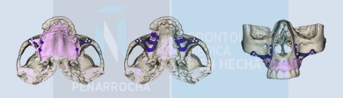 portada implantes dentales sin tornillos idim clinica de implantes dentales en valencia