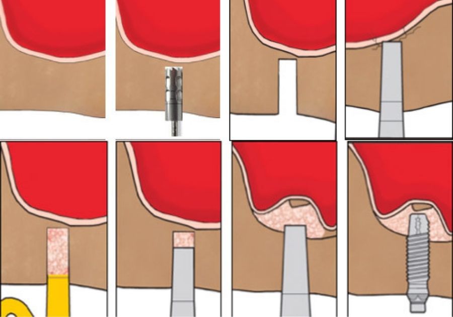elevacion de seno indirecta