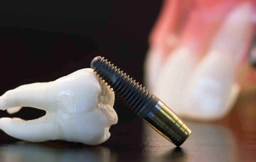 elevacion seno maxilar implantes dentales