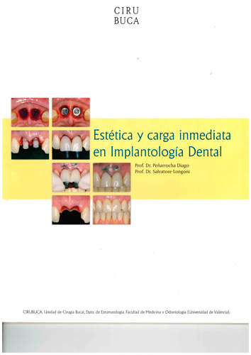 estetica y carga inmediata en implatologia dental