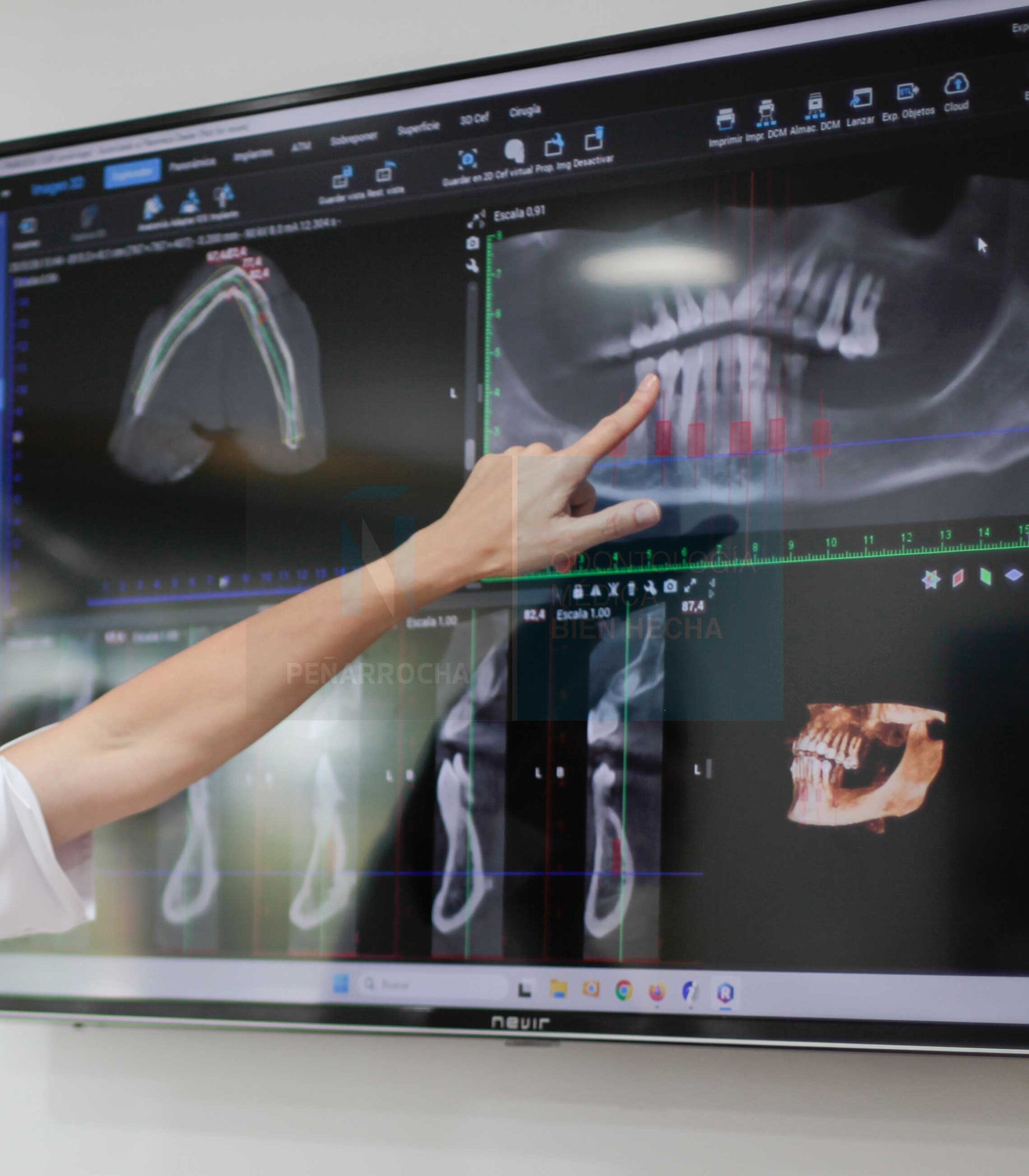 estudio-posibilidad-implantes-dentales-con-poco-hueso-en-valencia-idim-clinica-de-implantes-dentales-en-valencia