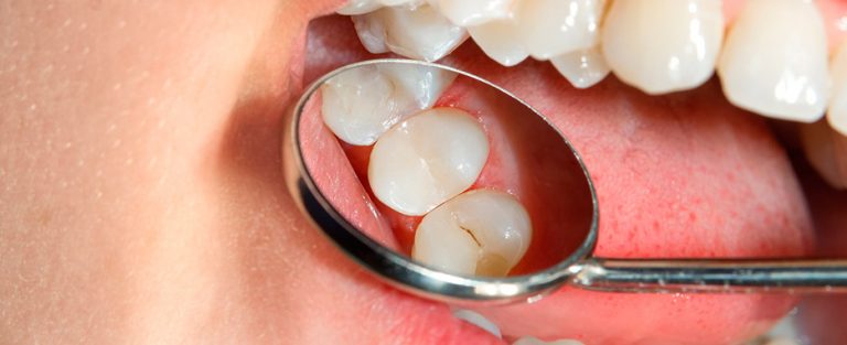 fumadores e implantes dentales