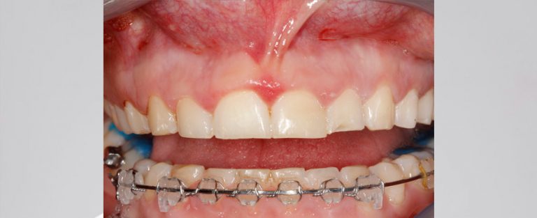 gingivectomia o alargamiento coronario