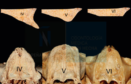 grado atrofias implantes dentales con poco hueso en valencia idim clinica de implantes dentales en valencia