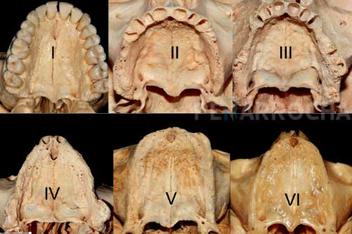 grados atrofia en maxilar atrofico idim clincia de implantes dentales en valencia