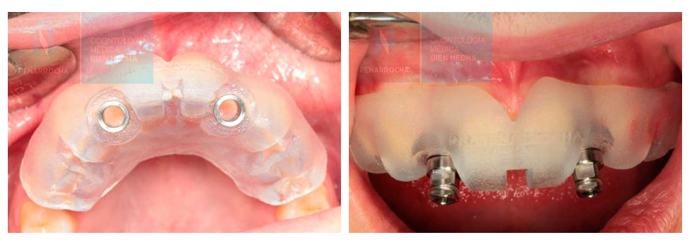 guia quirurgica colocacion implantes dentales sin cirugia en valencia IDIM clinica de implantes dentales en valencia