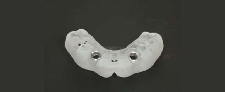 implantes dentales en un dia IDIM clinica de implantes dentales en valencia